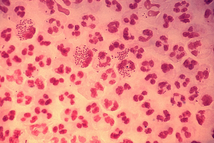 Gram stain of the bacteria causing gonorrhea