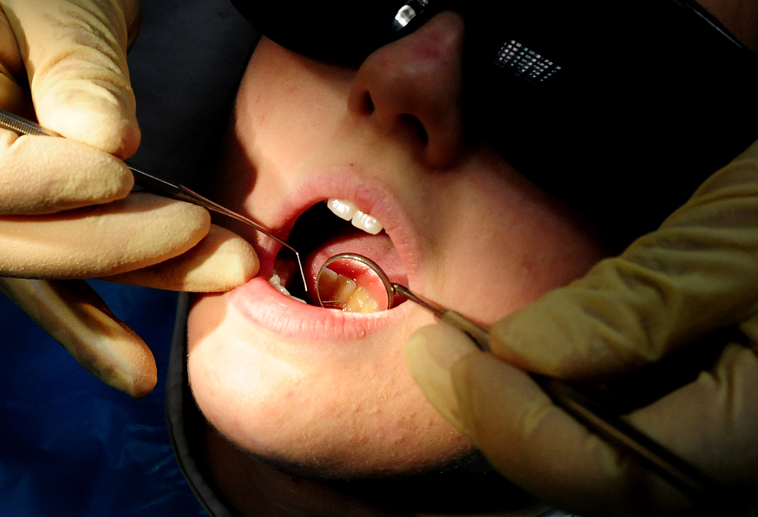 Almost 100 hospital admissions in Cornwall to remove children's rotten teeth