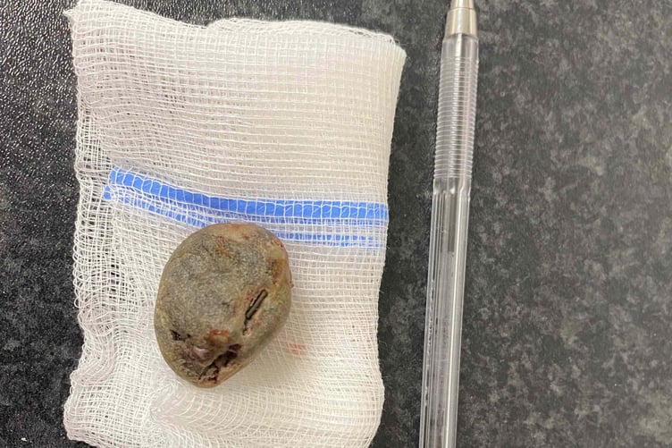 The pebble recovered from Lily's intestines which caused a blockage and potentially could have led to sepsis or a ruptured intestine.