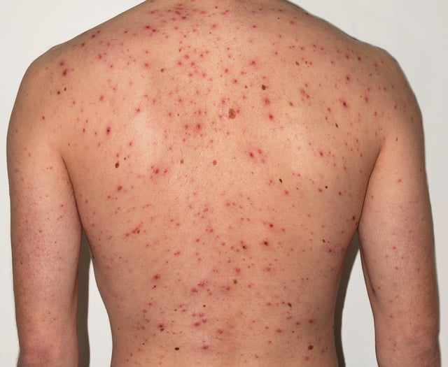 New NHS jab aims to cut chickenpox cases across Cornwall