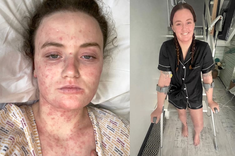 Skye had to learn to walk again after suffering from sepsis.